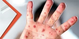 Aumentan casos de sarampión en San Luis Potosí durante 2026