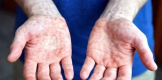 Culpa Robledo a Gobiernos neoliberales por sarampión